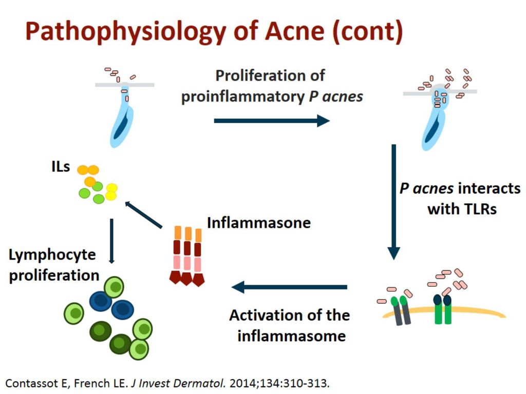 Pathophysiology of Acne (cont)