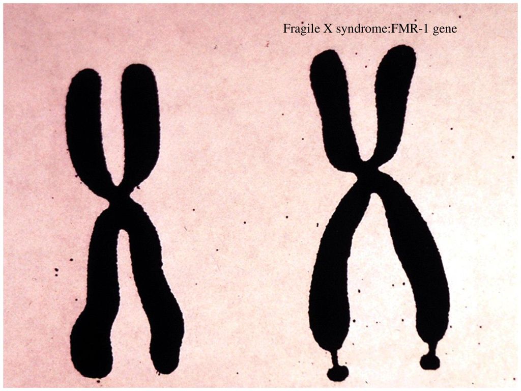 50 chromosome. Х И У хромосомы. Одна хромосома. Синдром ломкой x-хромосомы.