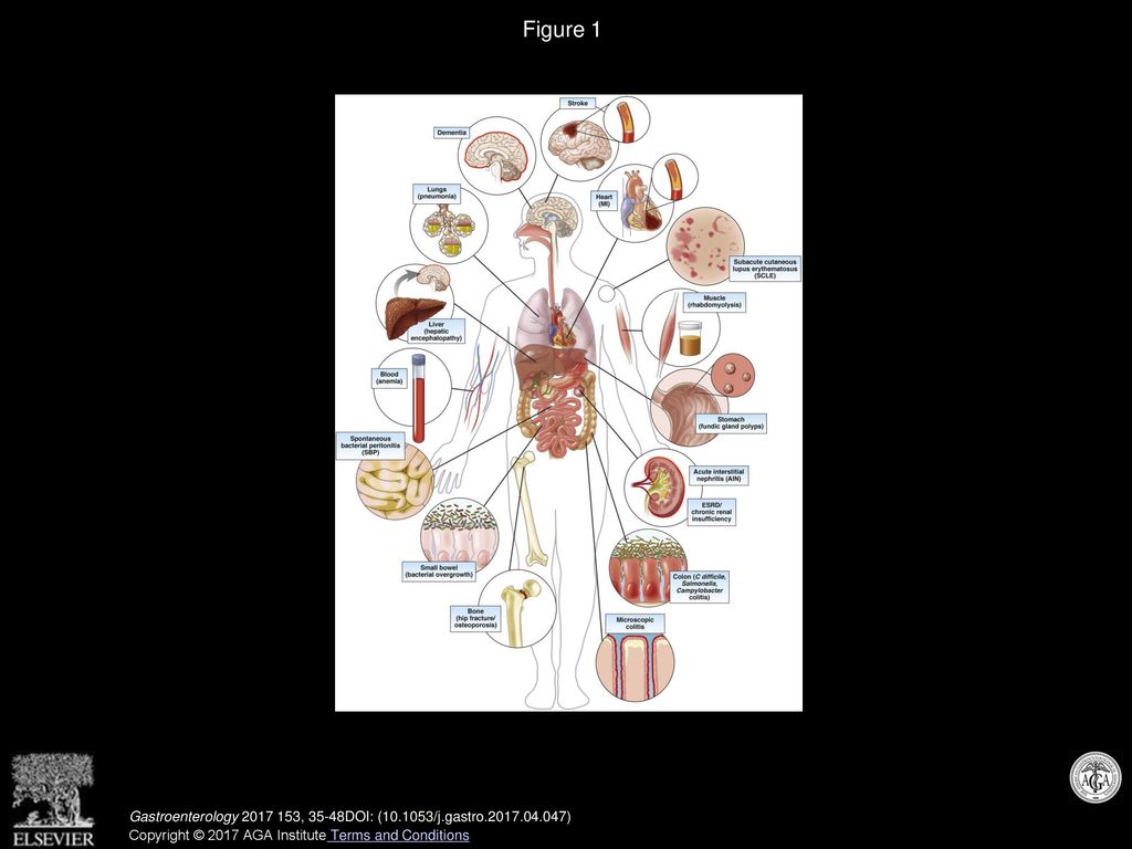 Figure 1 Schematic diagram of some of the reported adverse consequences of long-term PPI therapy.