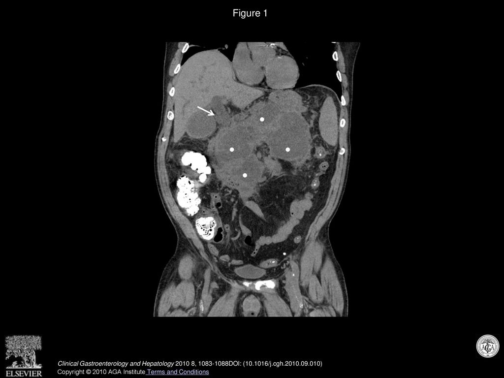 Figure 1 CT scan of patient with WOPN before CMT showing dilated common duct (arrowhead) and WOPN (white circles).