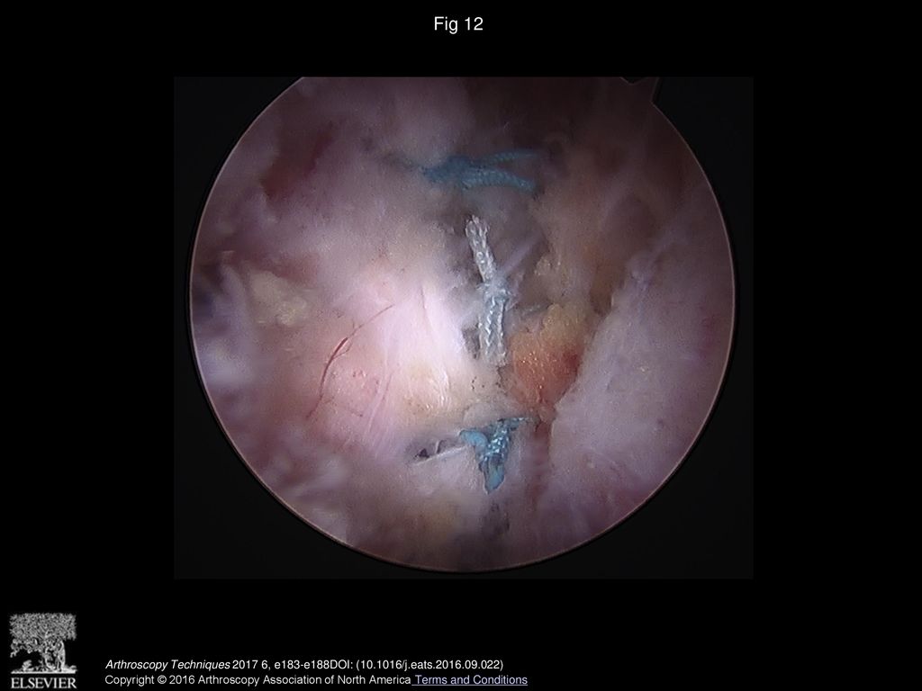 Fig 12 Supine endoscopic view after completion of side-to-side rectus abdominis repair with 3 sets of sutures.
