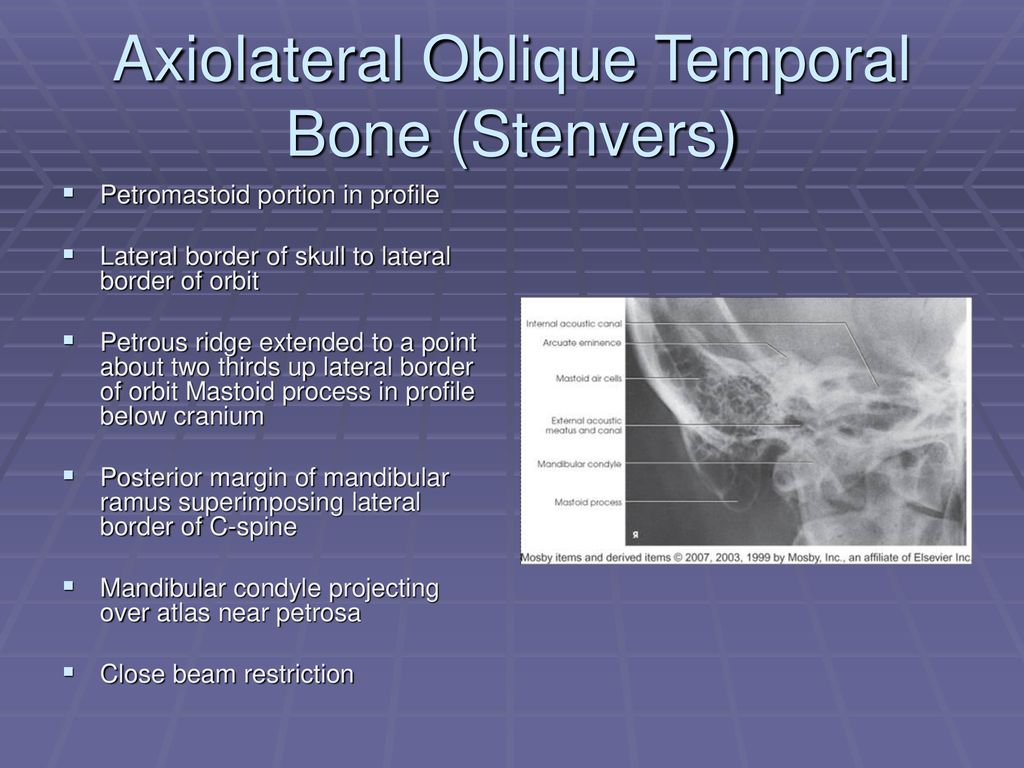 Axiolateral+Oblique+Temporal+Bone+%28Stenvers%29.jpg