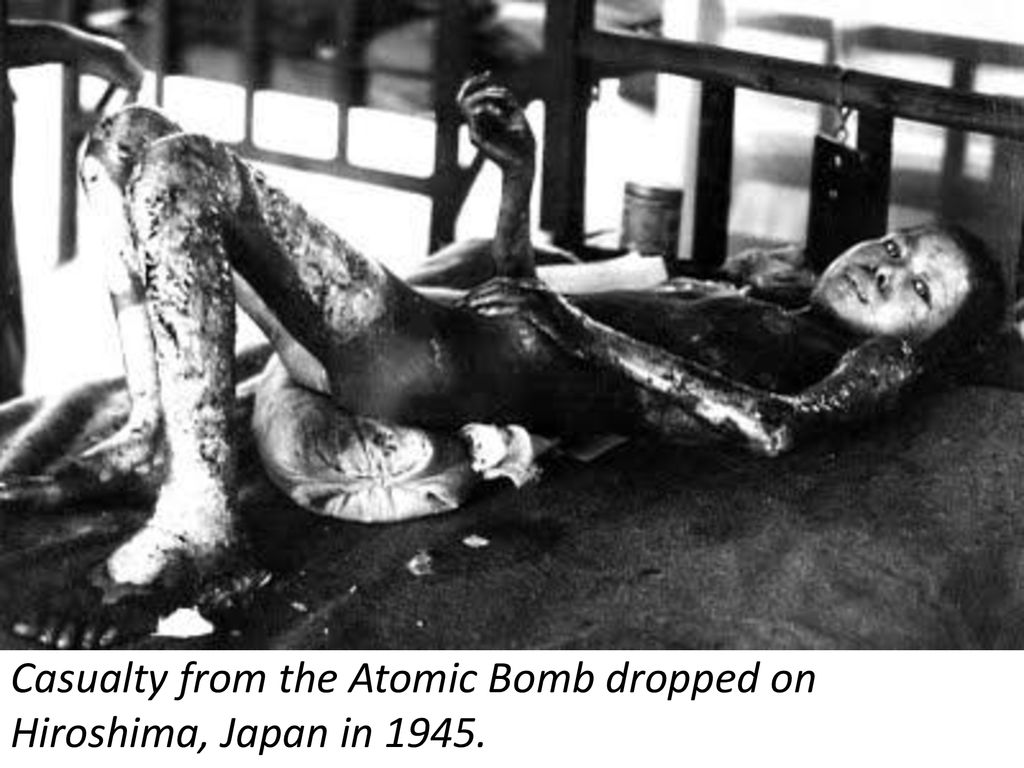 Casualty from the Atomic Bomb dropped on Hiroshima, Japan in 1945.