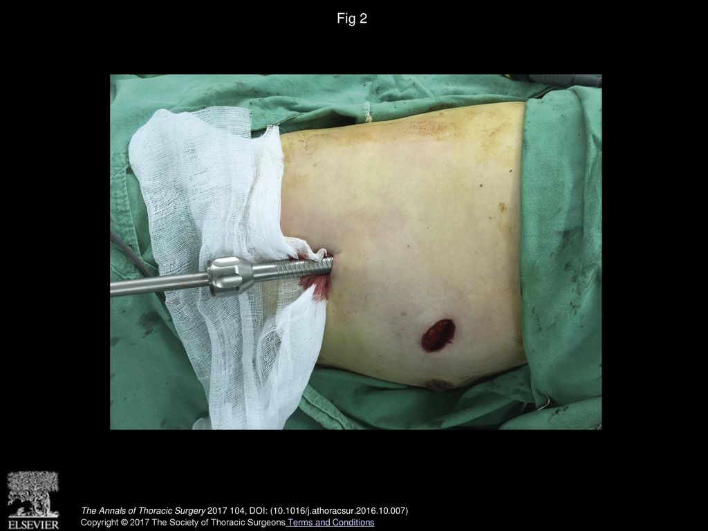 Fig 2 Unfolded gauze in two-port video-assisted thoracoscopic surgery.