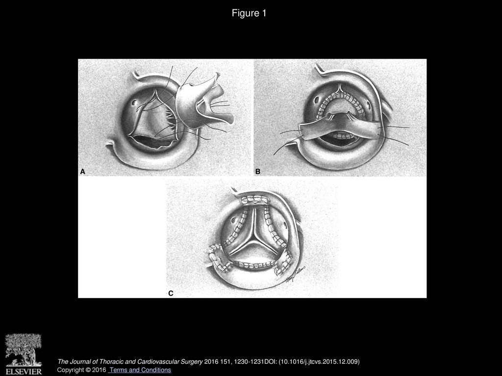 Figure 1 A-C, Infracoronary implantation of aortic valve homograft for extensive aortic root abscess.