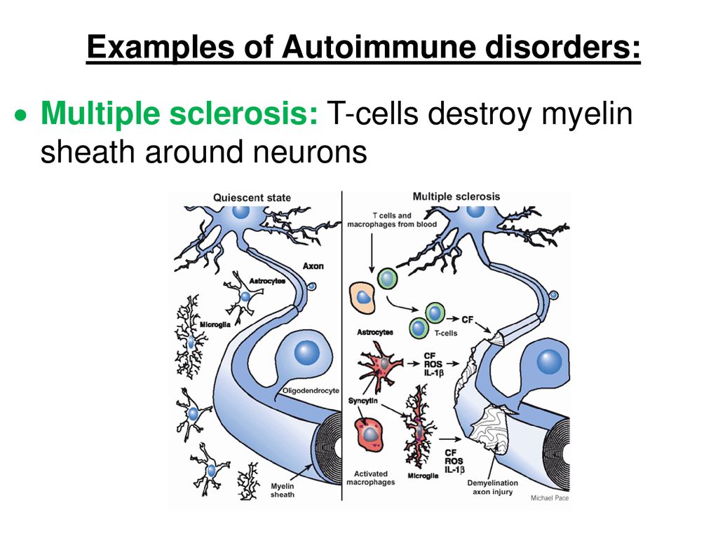 Examples of Autoimmune disorders: