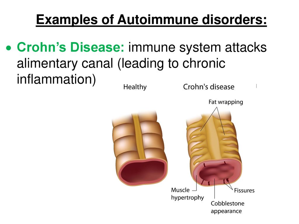 Examples of Autoimmune disorders: