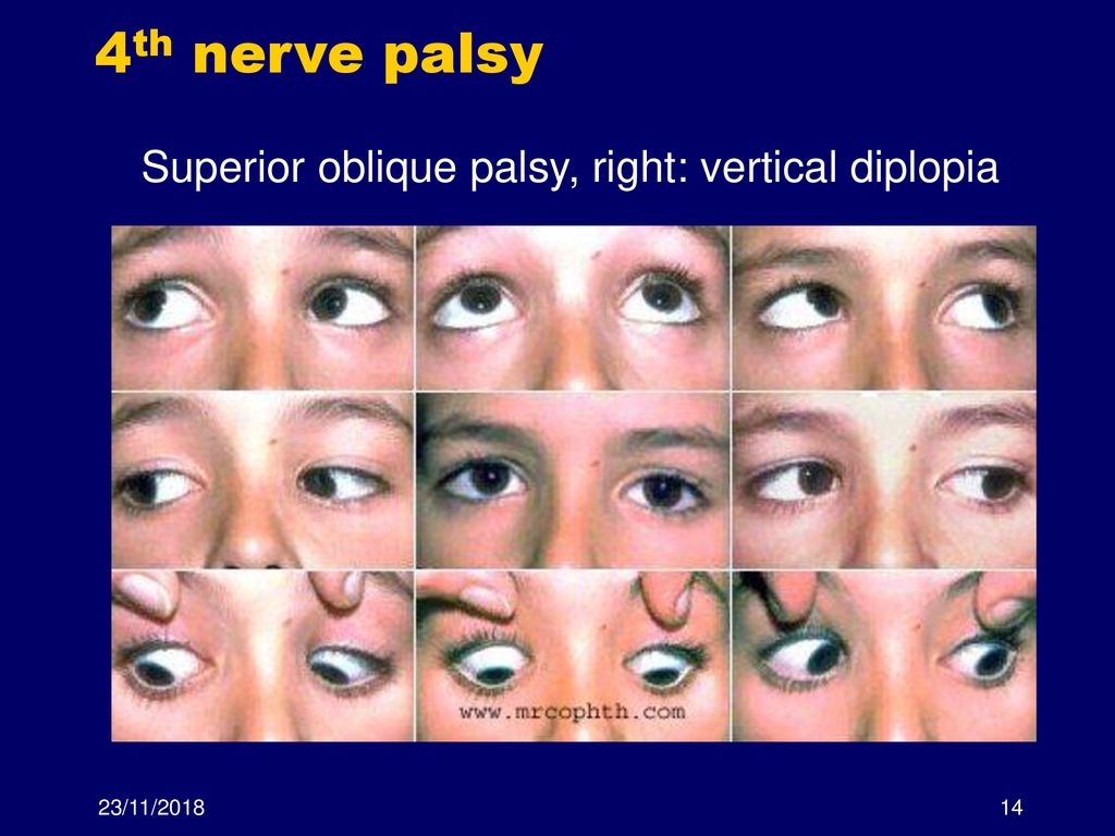 Neuro Ophthalmology Part 3 Crainial Nerves David Ppt Download