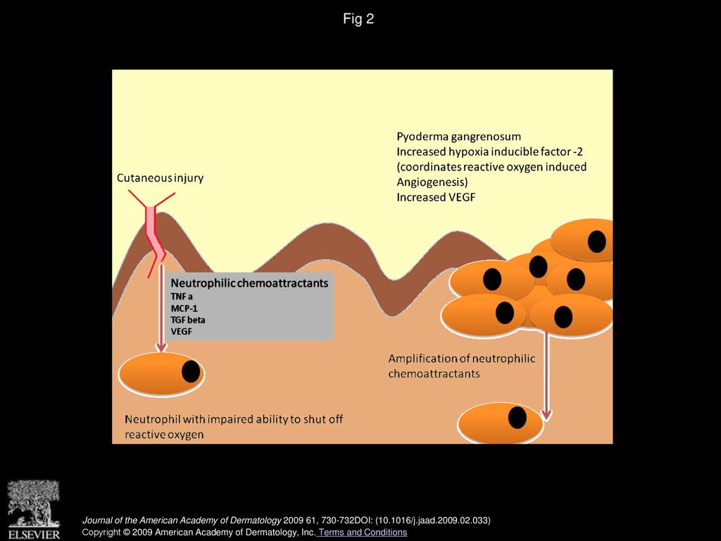 Disseminated Pyoderma Gangrenosum: Role For Vascular Endothelial Growth 