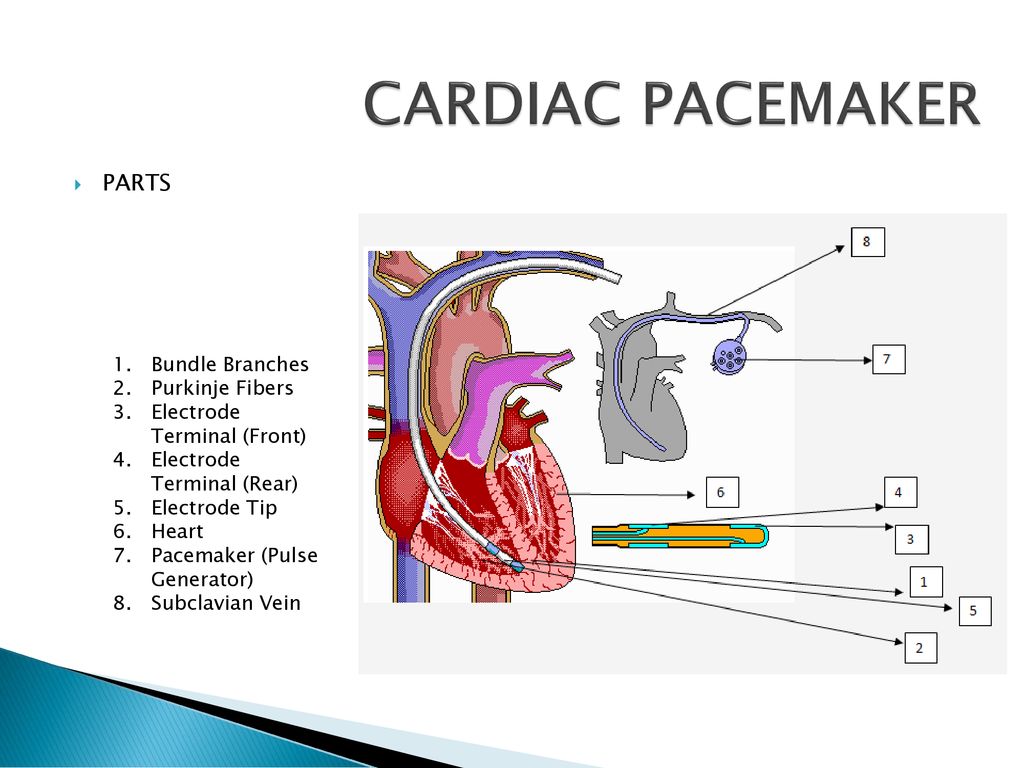 CARDIAC PACEMAKER A cardiac pacemaker is an electric stimulator that  produces electric pulses that are conducted to electrodes normally located  within. - ppt download