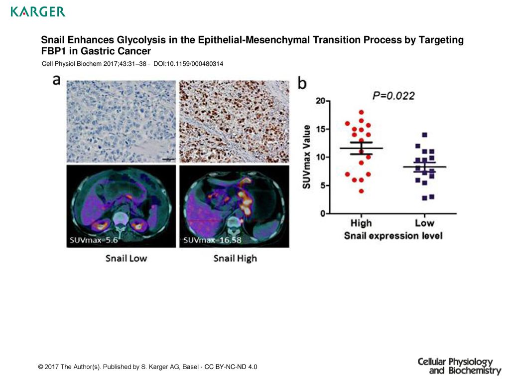 Snail Enhances Glycolysis in the Epithelial-Mesenchymal Transition Process by Targeting FBP1 in Gastric Cancer