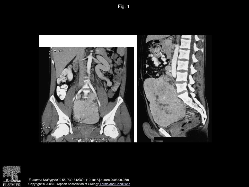 Fig. 1 Scan showing retroperitoneal mass with a radiologic diagnosis of hemangiopericytoma.
