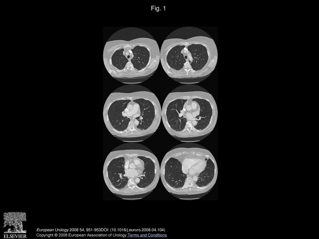 Fig. 1 CT scan of the chest demonstrating absence of metastases at 10 mo of follow-up.