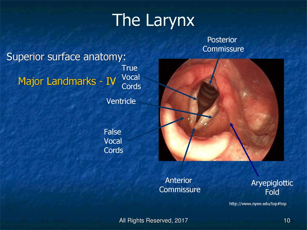 anterior commissure larynx