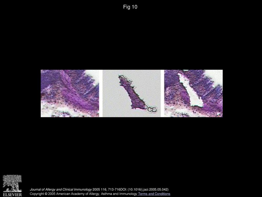 Fig 10 Example of a laser capture microdissection of ASMCs in a biopsy specimen obtained from an asthmatic subject.