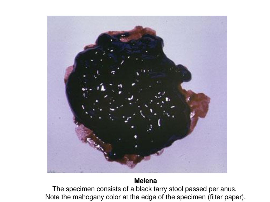 GI Pathology I, Case 3 37-year-old man presents with epigastric pain