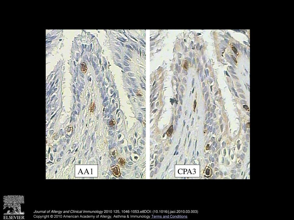 Immunostaining for tryptase (AA1 antibody) and CPA3 (CPA3 antibody) in a lung section from a patient with fatal asthma shows colocalization of tryptase and CPA3 in the airway epithelium.
