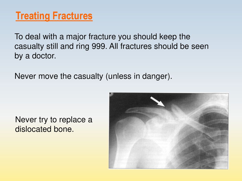 Treating Fractures To deal with a major fracture you should keep the casualty still and ring 999. All fractures should be seen by a doctor.