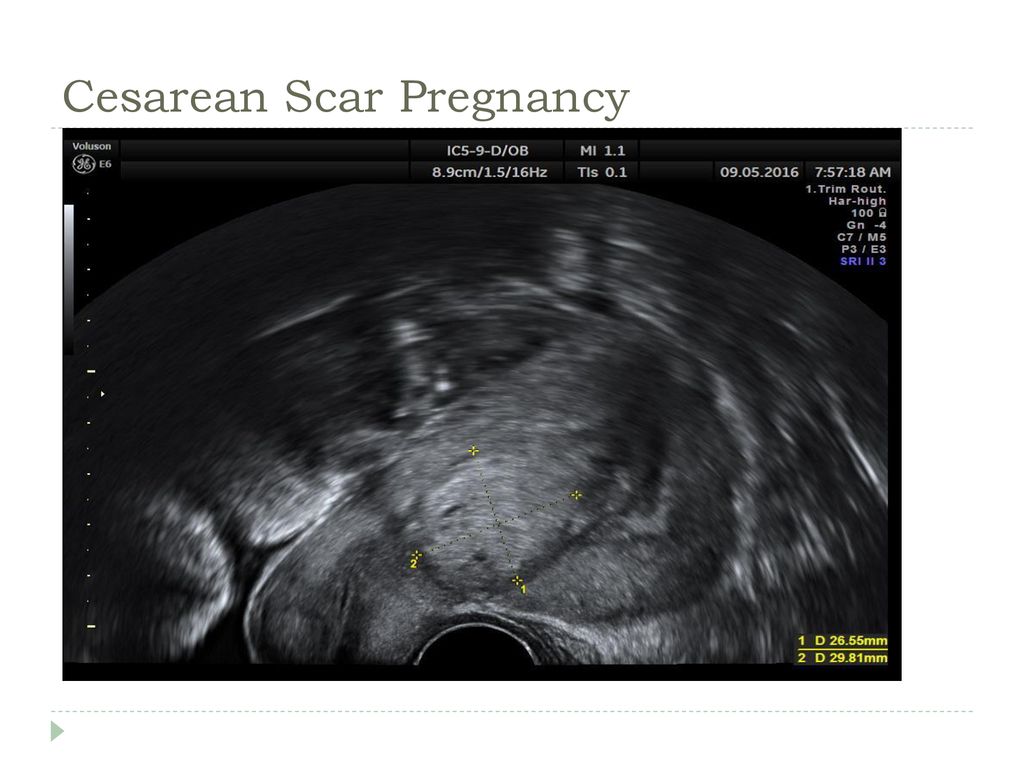 Cesarean Scar Pregnancy
