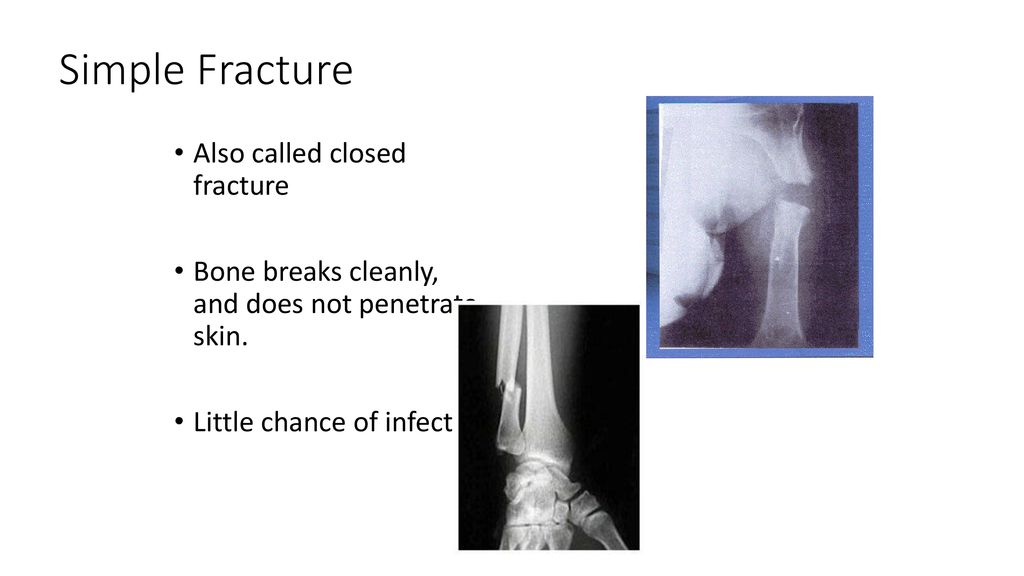 Simple Fracture Also called closed fracture