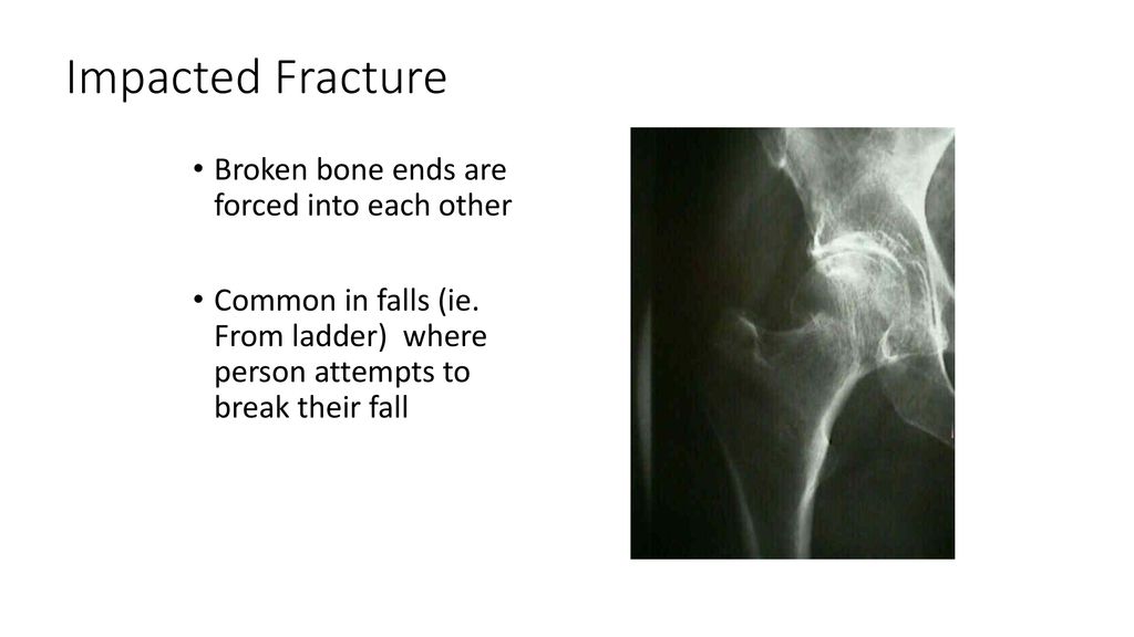 Impacted Fracture Broken bone ends are forced into each other