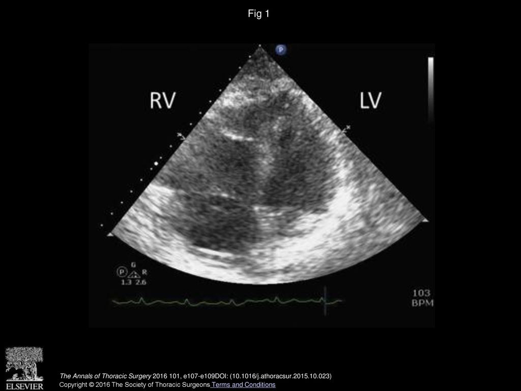Fig 1 Transthoracic echocardiography reveals a dilated right ventricle (RV). (LV = left ventricle.)