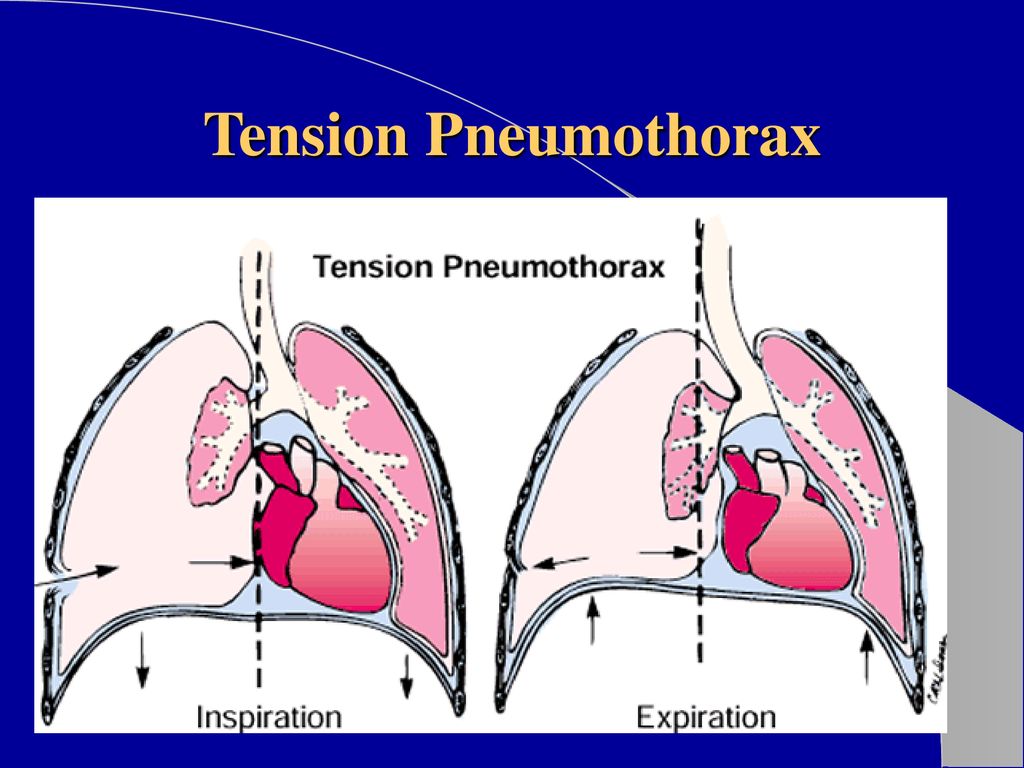 Thoracic Trauma. - ppt download Thoracic Trauma. - ppt download