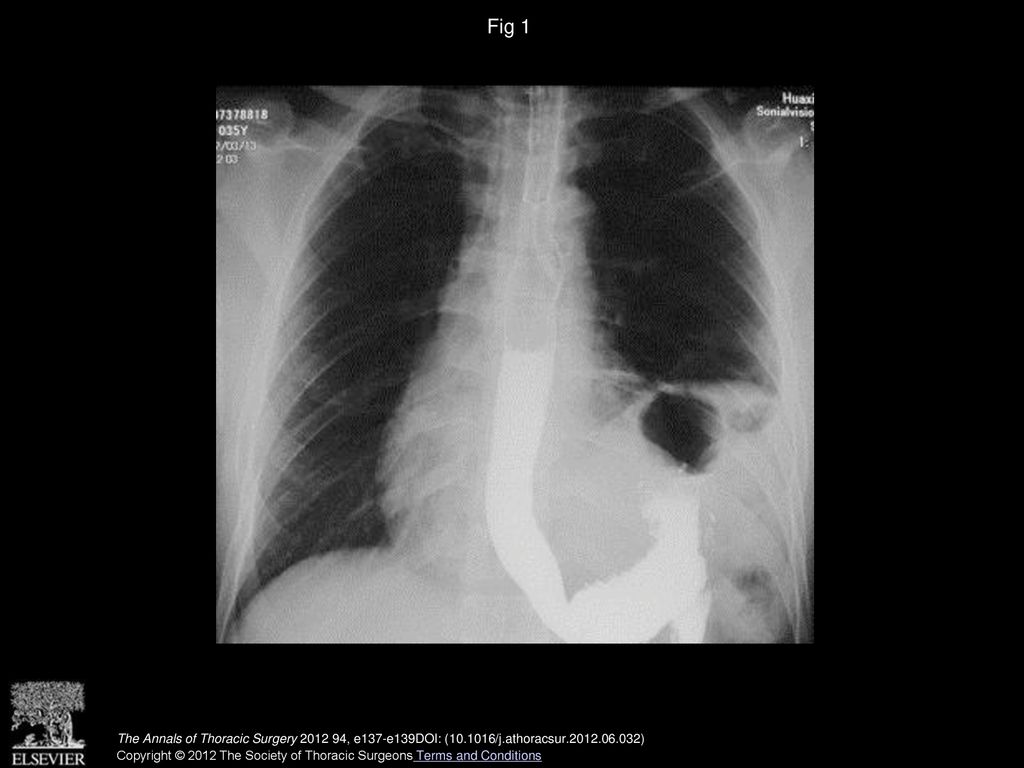 Fig 1 A barium meal examination show the stomach in the left hemithorax.