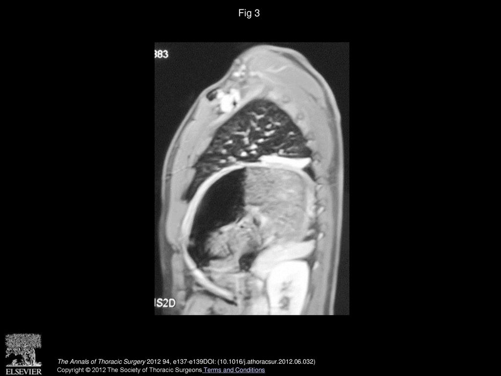 Fig 3 Magnetic resonance imaging. Contrast-enhanced sagittal reconstruction T1-weighted imaging revealed continued diaphragm wrapping the masses up.