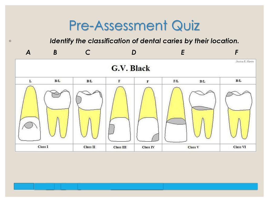A Review Of G V Black S Classification Of Dental Caries Ppt Download