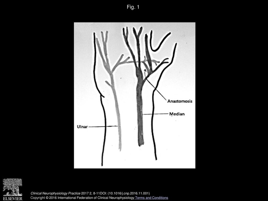 Fig. 1 Riche–Cannieu anastomosis in the hand, showing an anastomosis between the ulnar and median nerves.