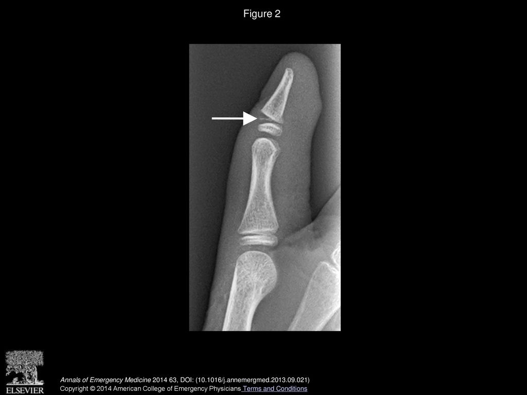 Figure 2 Lateral radiograph showing fracture fragment proximal to distal phalanx (arrow).
