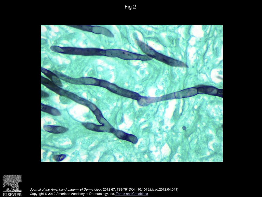 Fig 2 Cutaneous aspergillosis. Septate branching hyphae consistent with Aspergillus species. (Grocott stain; original magnification: ×400.)