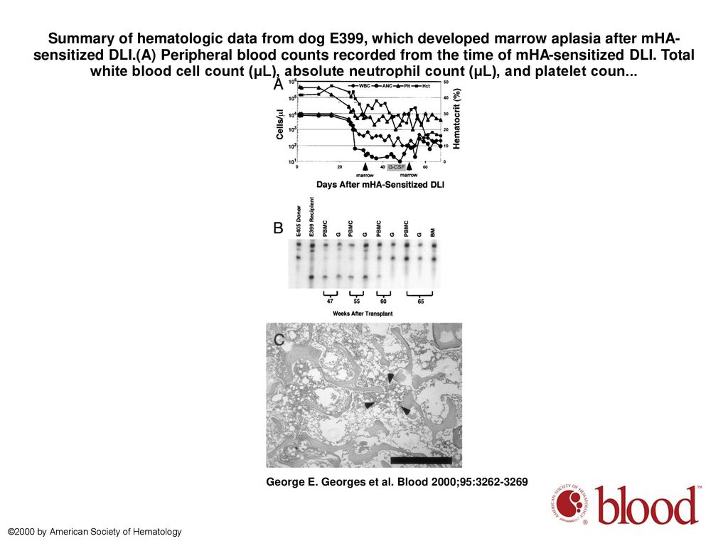 Summary of hematologic data from dog E399, which developed marrow aplasia after mHA-sensitized DLI.(A) Peripheral blood counts recorded from the time of mHA-sensitized DLI. Total white blood cell count (μL), absolute neutrophil count (μL), and platelet coun...