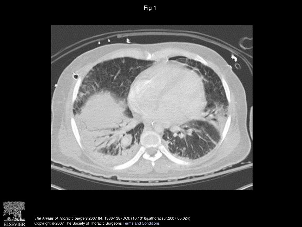 Fig 1 Computed tomographic scan of the chest with right lower and middle lobe pneumonia.