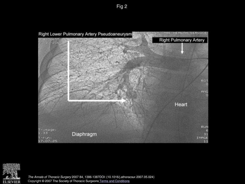 Fig 2 Angiogram of right pulmonary artery and right lower pulmonary artery pseudoaneurysm.