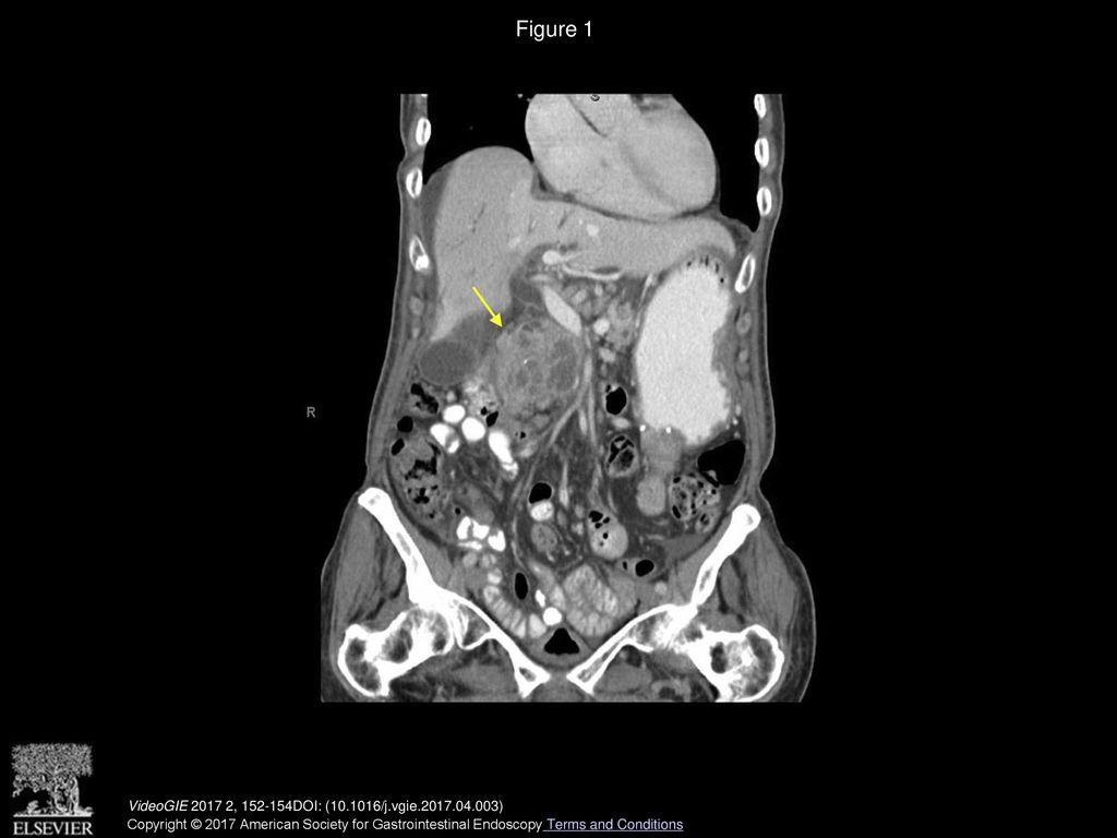 Figure 1 Contrast-enhanced CT view of abdomen showing soft-tissue mass in the duodenum causing gastric outlet obstruction.