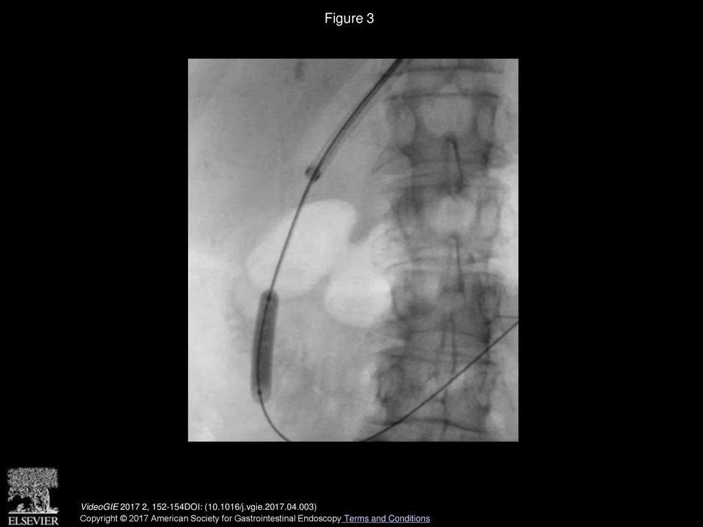 Figure 3 Fluoroscopic view showing biliary orifice dilation with an 8-mm dilation balloon. VideoGIE , DOI: ( /j.vgie )