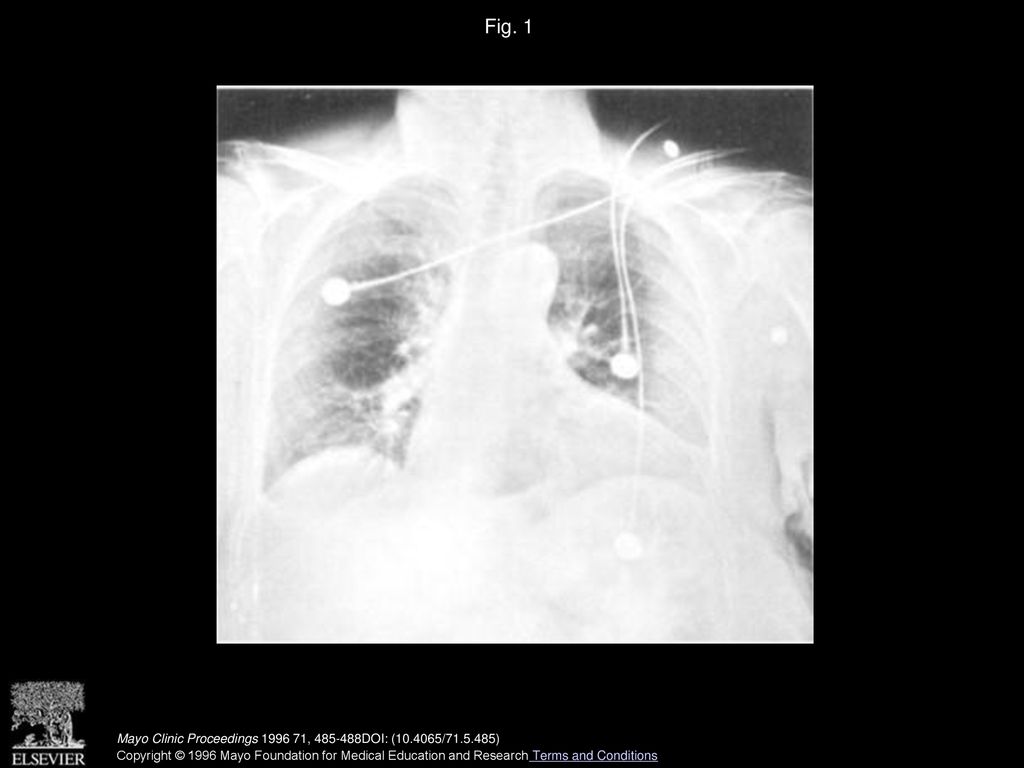 Fig. 1 Chest roentgenogram, showing small right pleural effusion and hiatal hernia. Mayo Clinic Proceedings , DOI: ( / )
