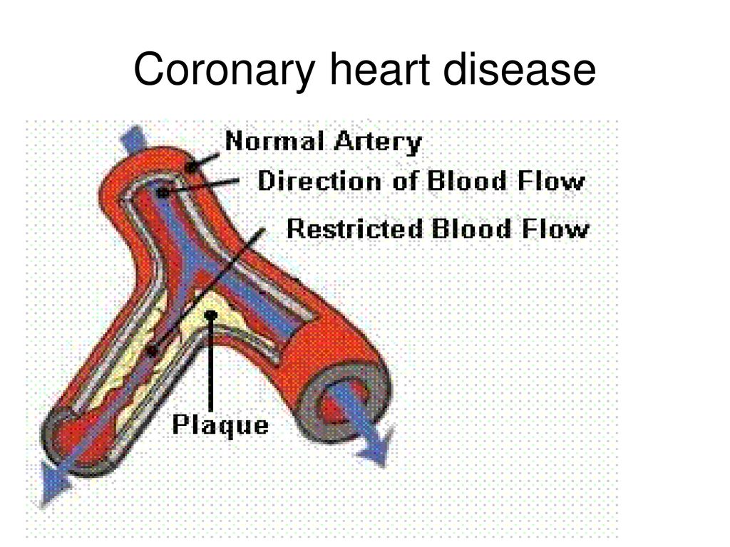 Meals Suitable For Coronary Heart Disease Meals Suitable For Coronary Heart Disease