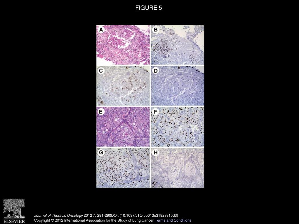 Δnp63 P40 And Thyroid Transcription Factor 1 Immunoreactivity On