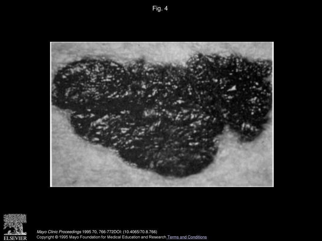 Fig. 4 Malignant melanoma with large black, ill-defined, plaquelike lesion. Mayo Clinic Proceedings , DOI: ( / )