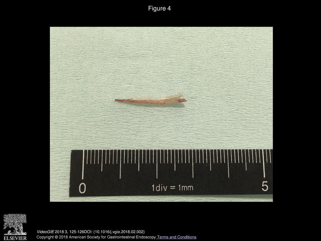 Figure 4 Fish bone after removal, measuring approximately 2 cm in length. VideoGIE , DOI: ( /j.vgie )