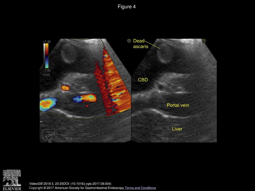 Figure 4 Dual-color Doppler image showing avascular hyperechoic structure with vascular portal vein. CBD, common bile duct.
