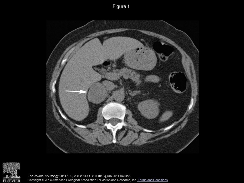Figure 1 Unenhanced axial CT shows homogeneous 4 cm right adrenal mass with CT density of 30 HU (arrow) posterior to inferior vena cava.