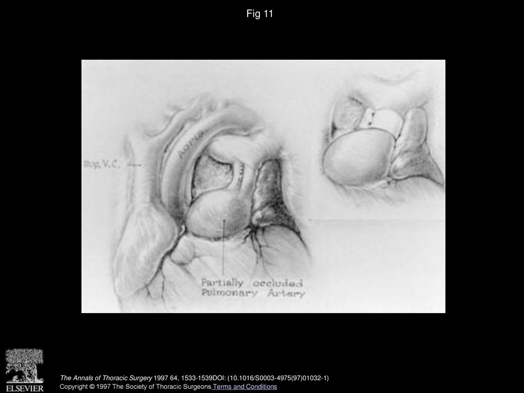 Fig 11 Pulmonary artery banding.