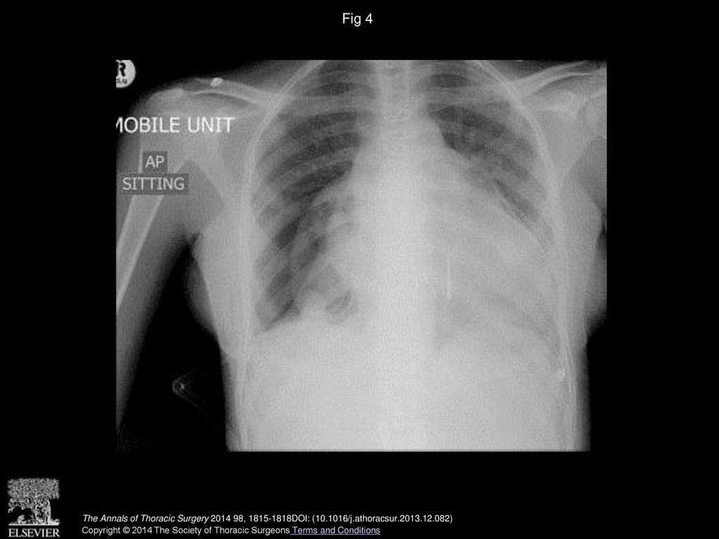 Fig 4 Three-week postoperative chest radiograph demonstrating the persistent residual pericardial space.