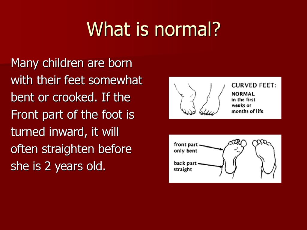 Club feet observations and possible solutions ppt download