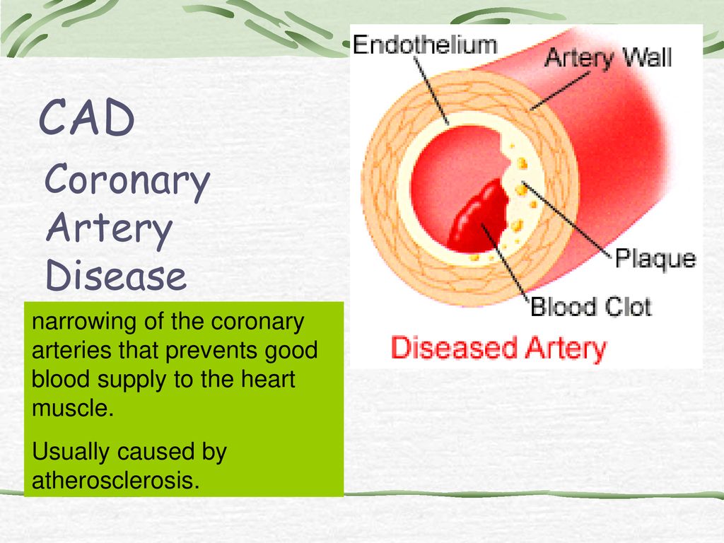CAD Coronary Artery Disease