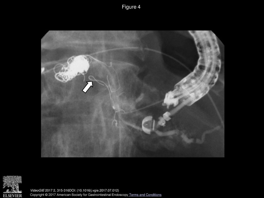 Figure 4 Attempt to pass a inch guidewire antegrade through the puncture site to the pancreatic head (arrow).
